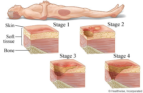 Bed Sores